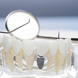 Dental İmplantlar